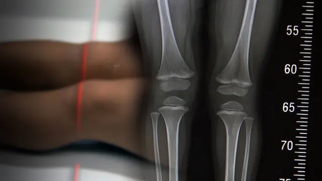 "5cm라도 더 컸으면"…'키 크는 주사' 열풍에 숨은 진실